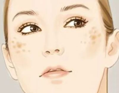 黄褐斑是怎么形成的